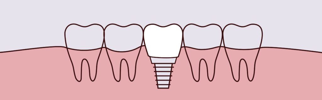 Dreamscape Imagery 05 1024x318 1 dental implants Matias Dental Group