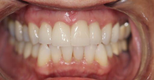 Teeth-1-After.jpeg