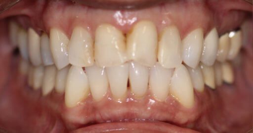 Teeth-1-Before.jpeg