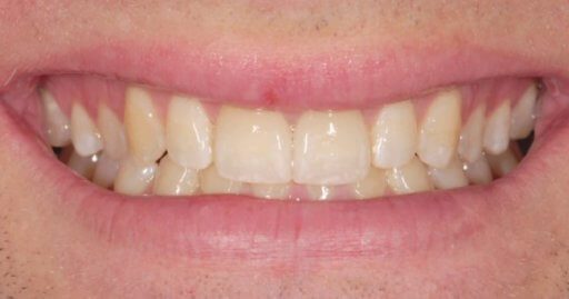 Teeth-2-After.jpeg