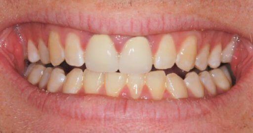 Teeth-2-Before.jpeg