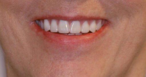 Teeth-4-After.jpeg