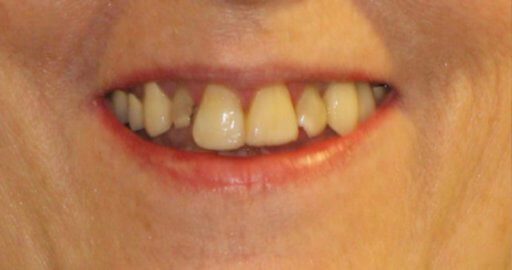Teeth-4-Before.jpeg