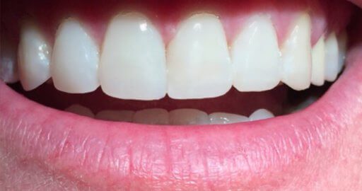 Teeth-5-After.jpeg