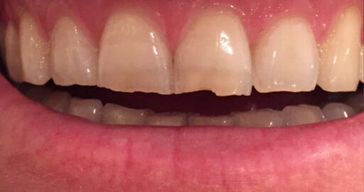Teeth-5-Before.jpeg