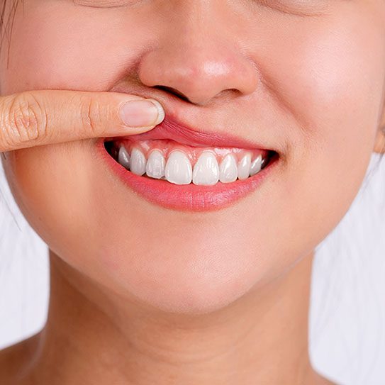 gum recession 2024 543 Matias Dental Group