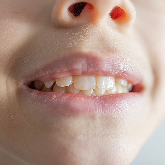 child gum disease 2024 543 Matias Dental Group