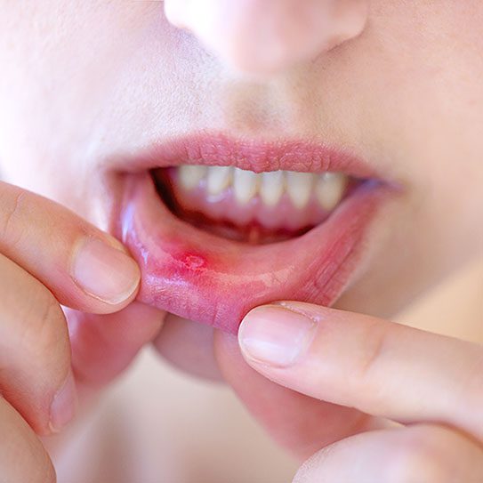 canker sore 2025 543 Matias Dental Group